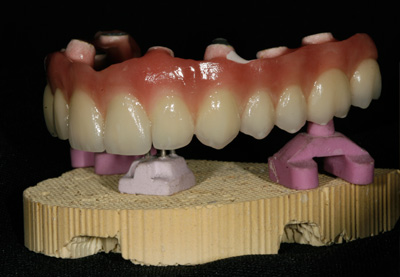 haupt-dental-lab-implants-sm